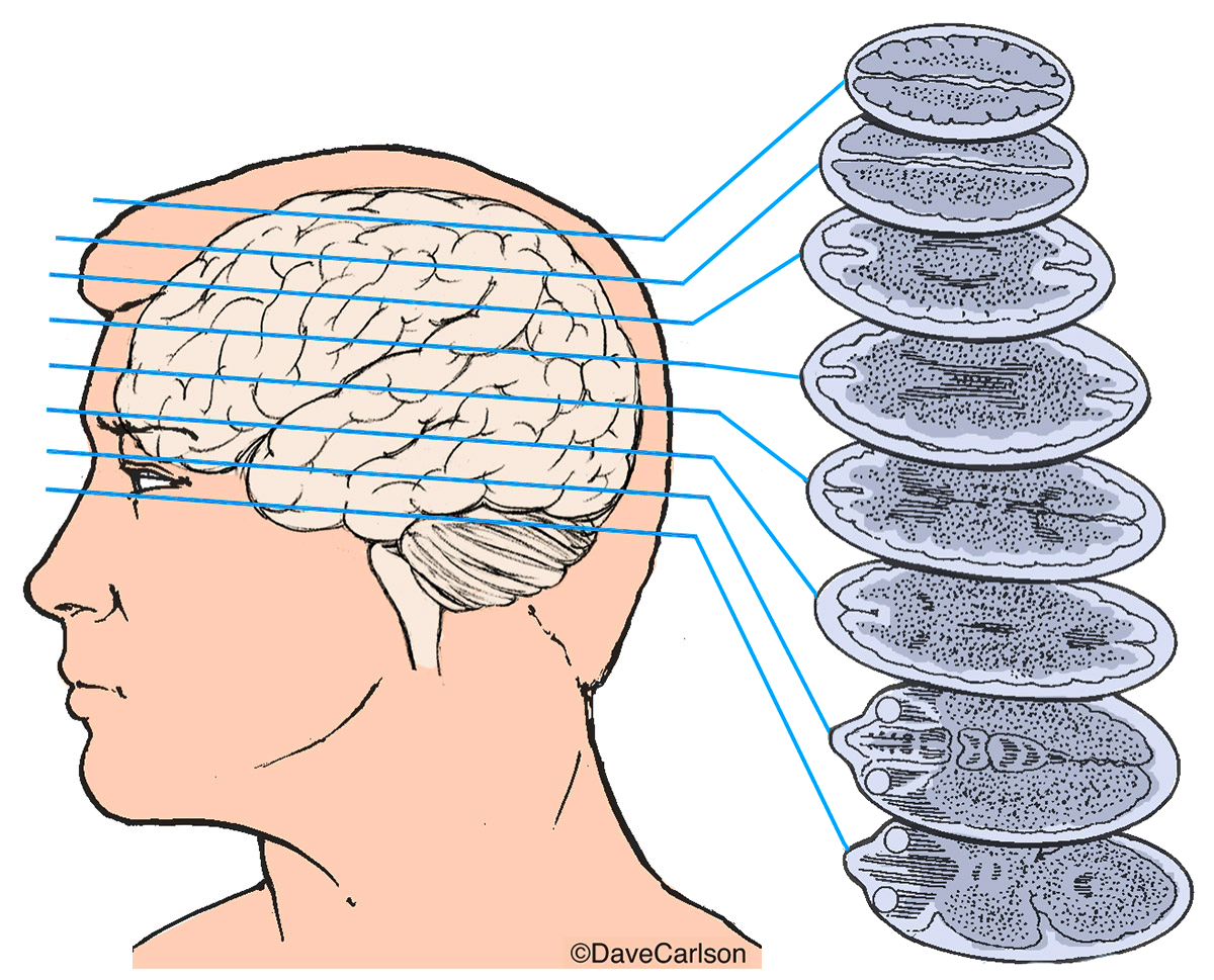 Computed Tomography Brain Scan
