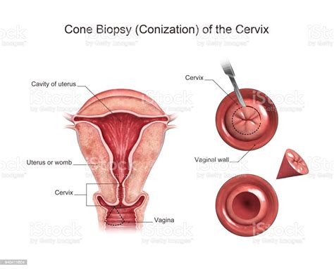 Cone Biopsy Illustration Stock Photo Download Image Now Anatomy Cone Biopsy Illustration Stock Photo Download Image Now Anatomy