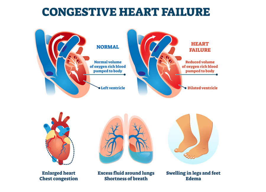 Congestive Heart Failure Espanol