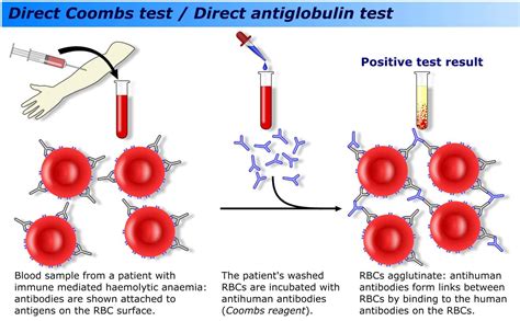 Coombs Test Results Explained