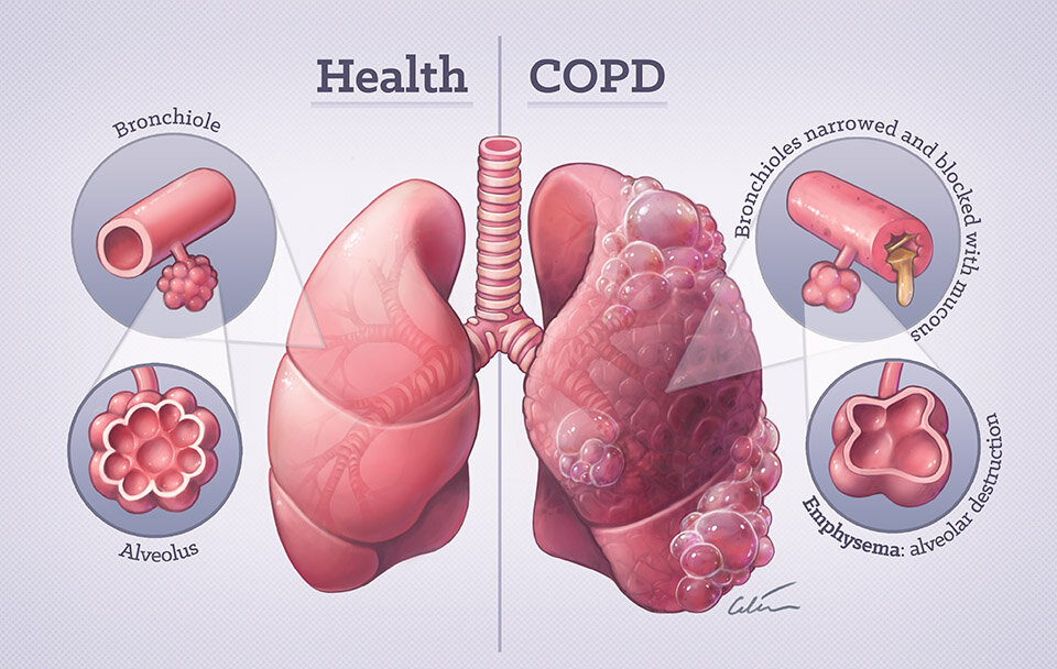Copd Inhalers: Manage Symptoms Effectively