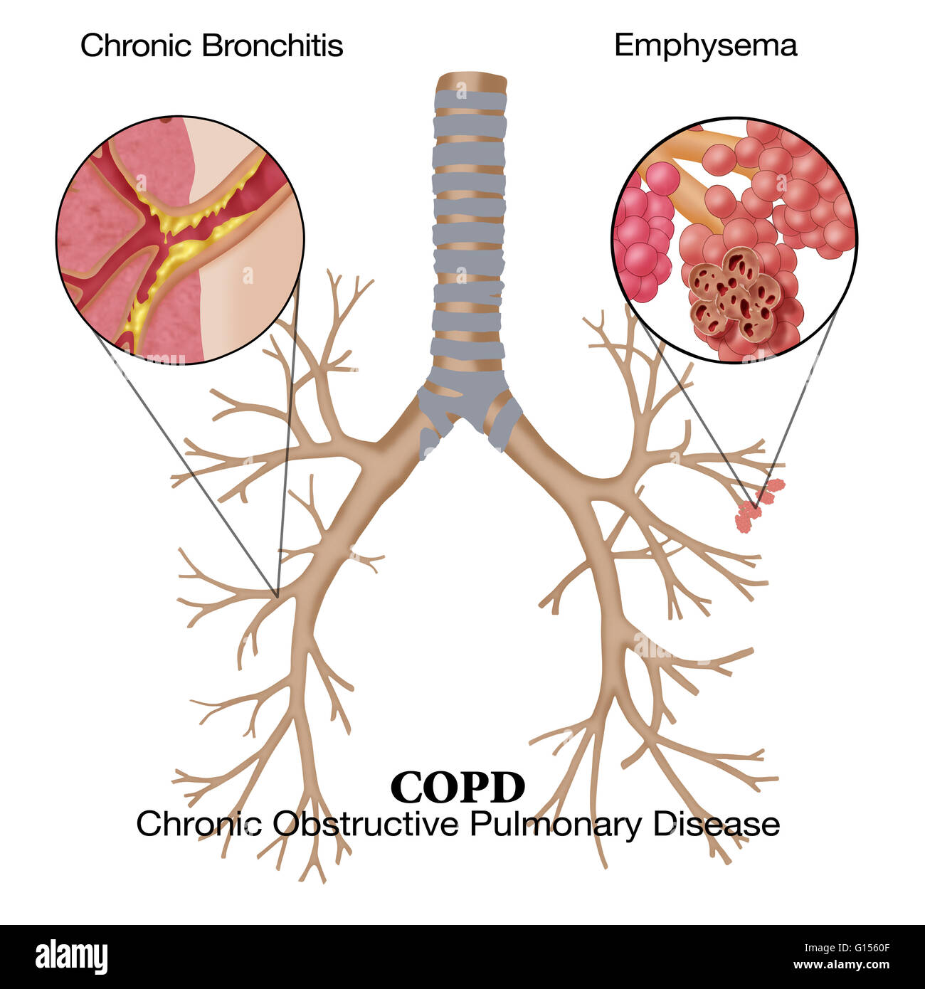 Copd Natural Treatment