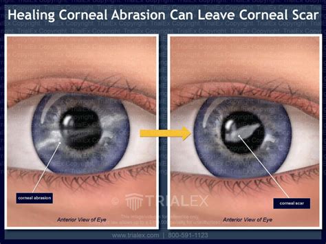 Corneal Abrasion Healing Time