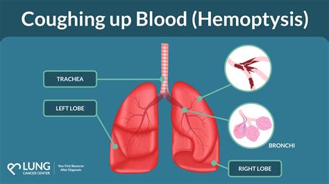 Coughing Up Blood Hemoptysis Is It A Lung Cancer Symptom Coughing Up Blood Hemoptysis Is It A Lung Cancer Symptom