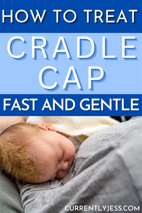 Cradle Cap Removal: Fast Natural Relief