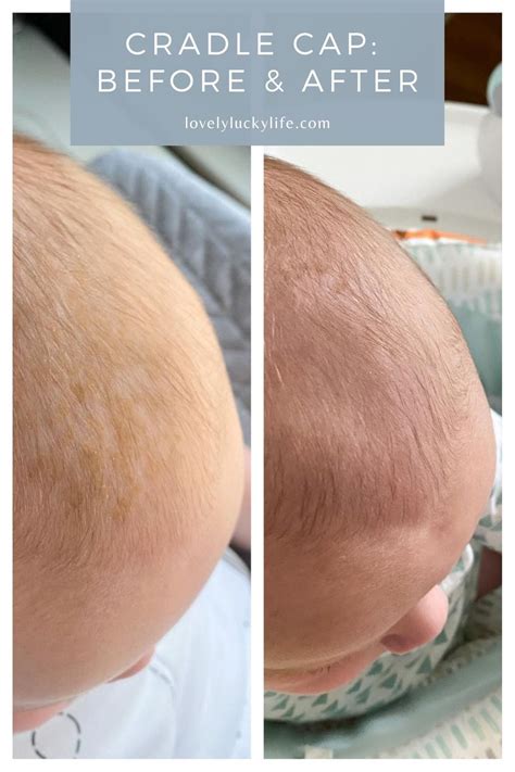 Cradle Cap Treatment: Gentle Remedies