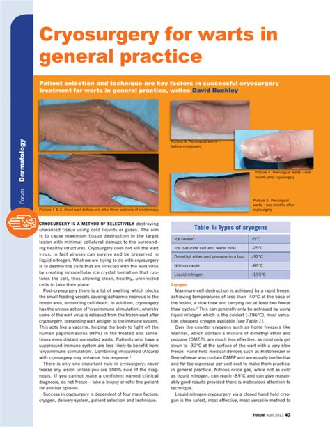 Cryosurgery For Warts In General Practice Cryosurgery For Warts In General Practice