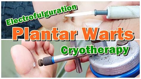 Cryotherapy And Warts