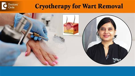 Cryotherapy Wart Removal Guide