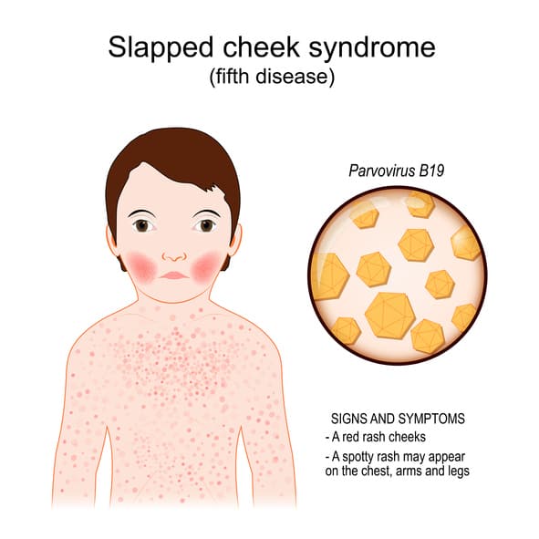Cure For Fifths Disease