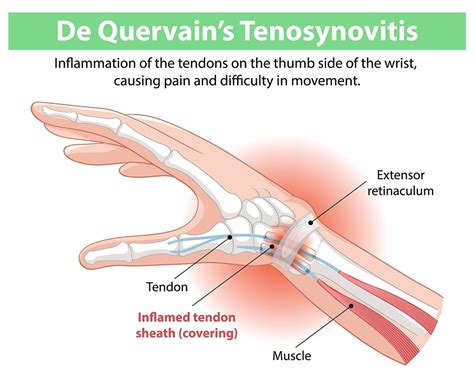De Quervain's Tenosynovitis: Ease Wrist Pain