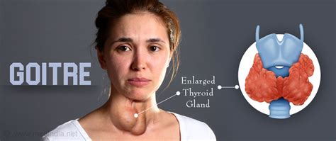 Define Goiter Disease