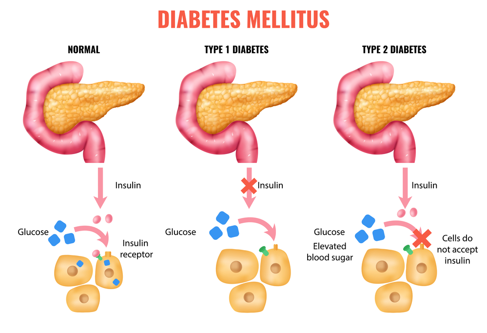Diabetes Glucose Control: Master Your Levels