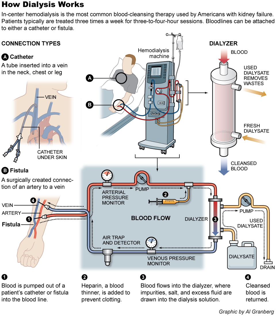 Dialysis Catheter Placement: Expert Procedure Insights