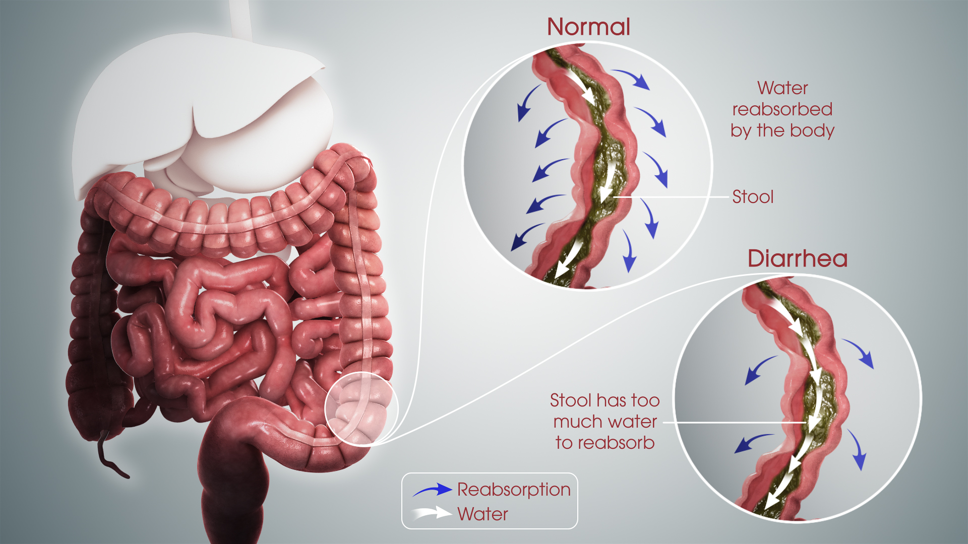 Diarrhea In Children Causes Symptoms Treatment About Pakistan Diarrhea In Children Causes Symptoms Treatment About Pakistan