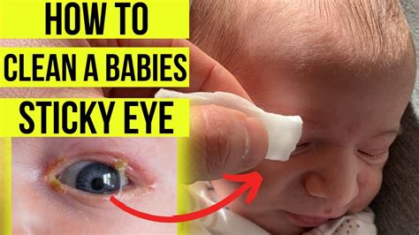 Discharge In Baby's Eye