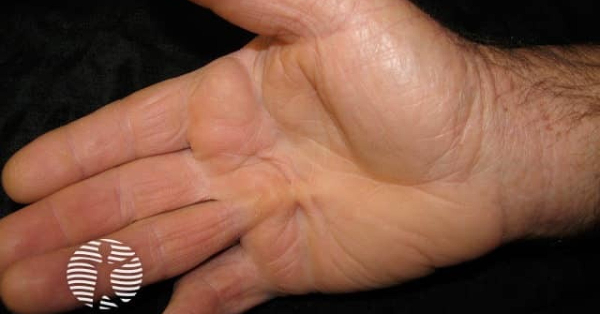 Dupuytren Contracture Ambulatory Care
