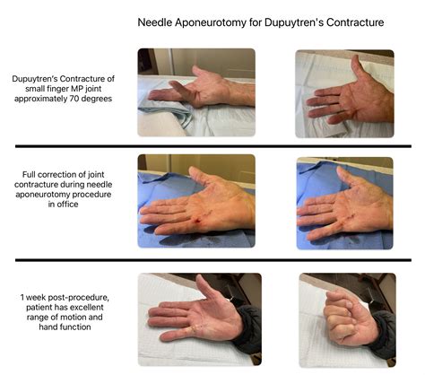 Dupuytren's Surgery: Effective Treatment For Contracture Relief