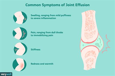Effusion Shoulder Joint: Relieve Pain Now