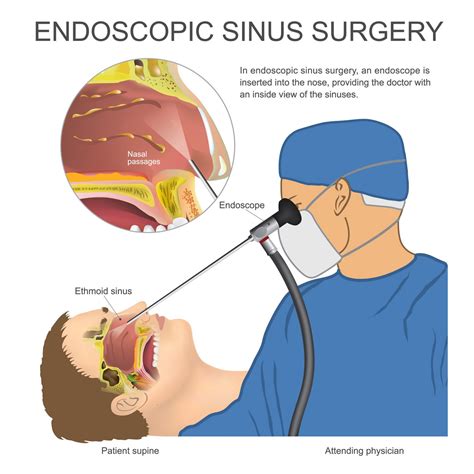 Endoscopic Sinus Surgery