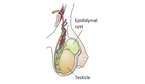 Epididymal Cyst Treatment