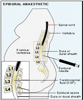 Epidural Pros Cons Guide