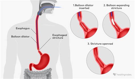 Esophageal Stricture Symptoms