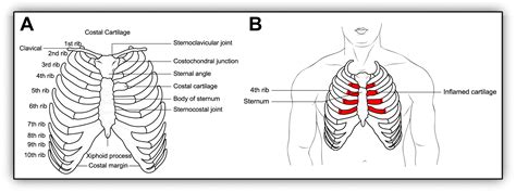 Evaluation And Treatment Of Musculoskeletal Chest Pain Primary Care Evaluation And Treatment Of Musculoskeletal Chest Pain Primary Care