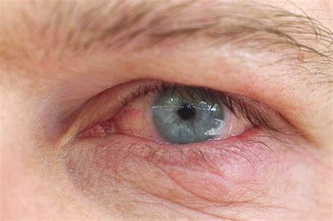 Eye Dryness With Contacts