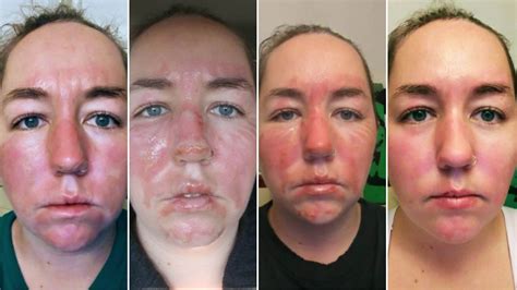 Face Chemical Burn