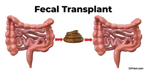 Fecal Transplant Guide: Heal Your Gut