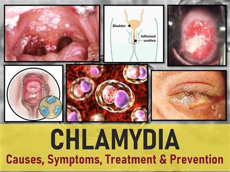 Female Chlamydia Symptoms
