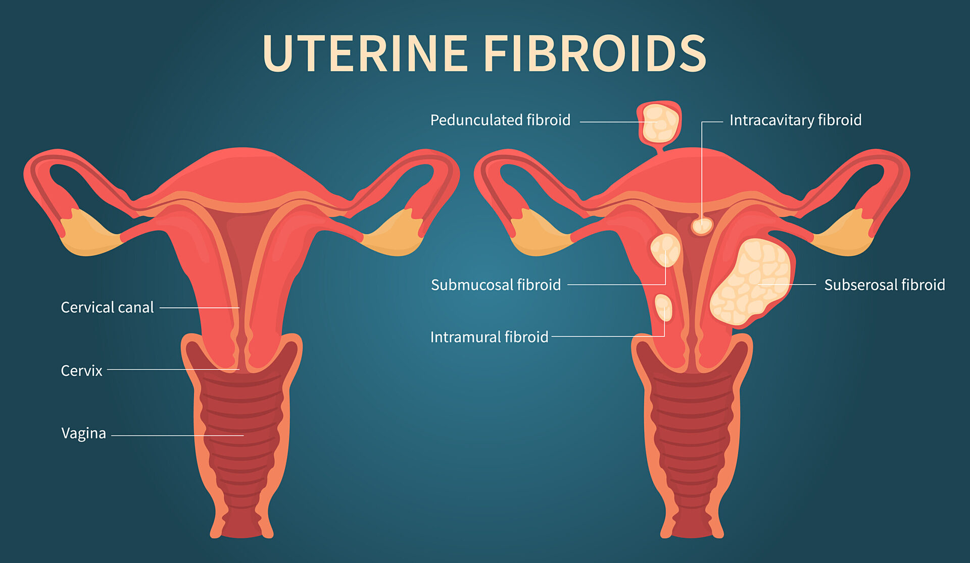 Fibroid Tumor In Uterus Treatment