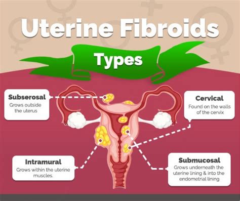 Fibroids Treatments Singapore Dr Pamela Tan Gynaecologist Singapore Fibroids Treatments Singapore Dr Pamela Tan Gynaecologist Singapore