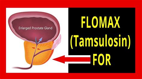 Flomax Treatment Guide: Enlarged Prostate Solutions