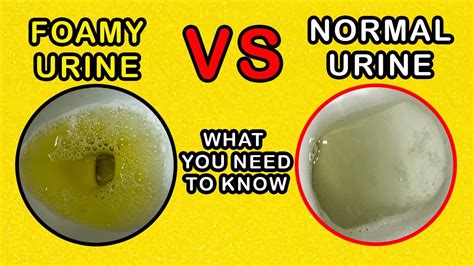 Foamy Urine Definition