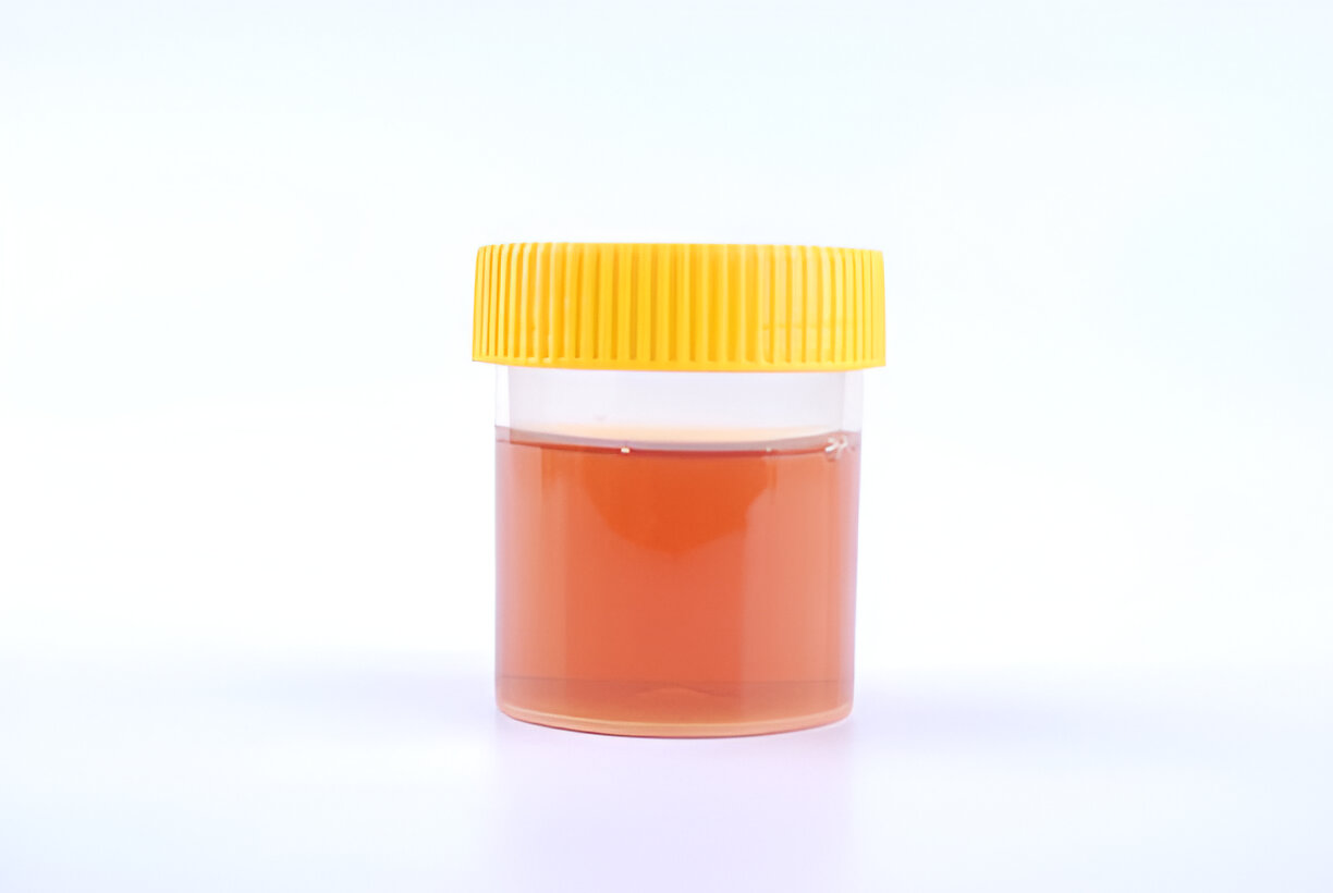 Foamy Urine Explained: Causes Uncovered