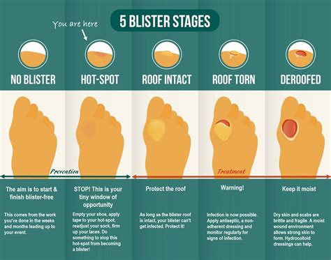 Foot Blister Care: Prevent And Treat Effectively