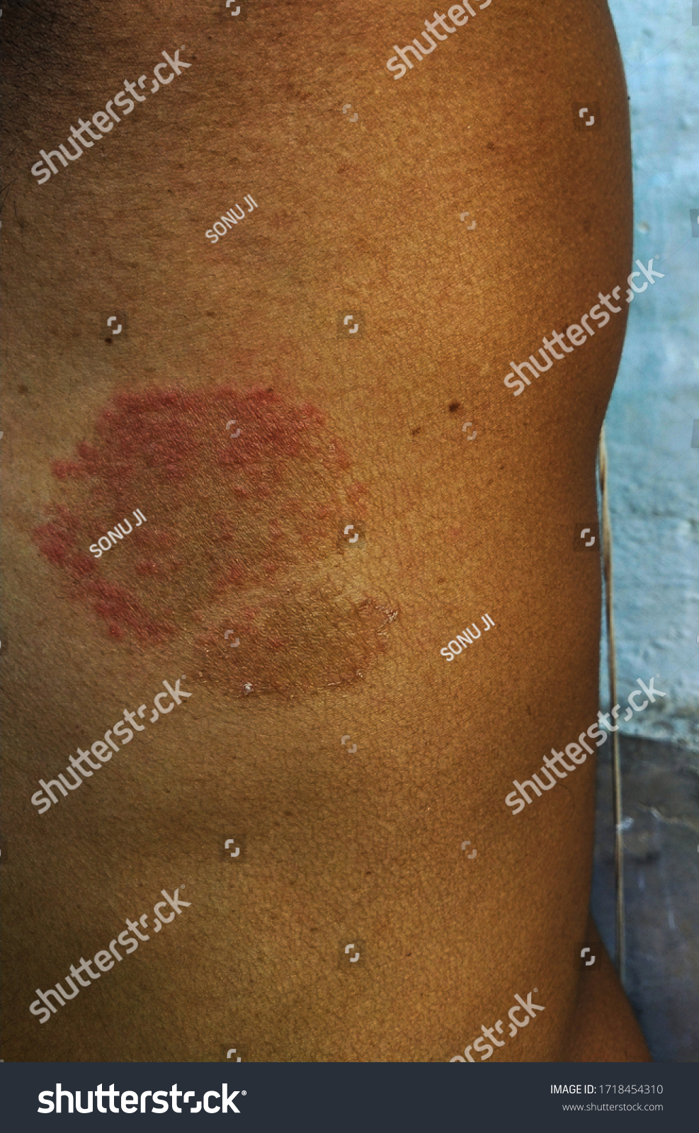 Fungal Armpit Infection: Natural Cure Solutions