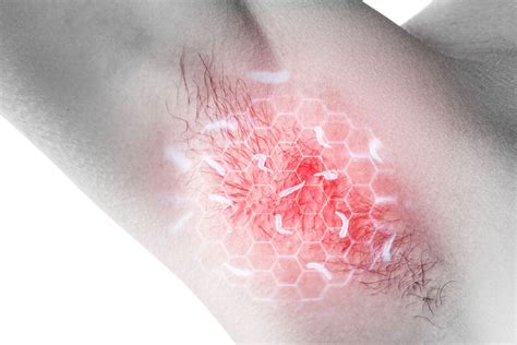 Fungal Infection Armpit: Get Quick Relief