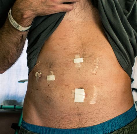 Gall Bladder Surgery Recovery Time