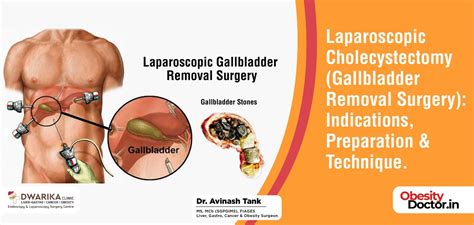 Gallbladder Removal: Recover Faster Naturally