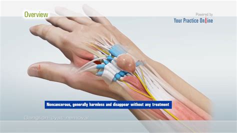 Ganglion Cyst Surgery
