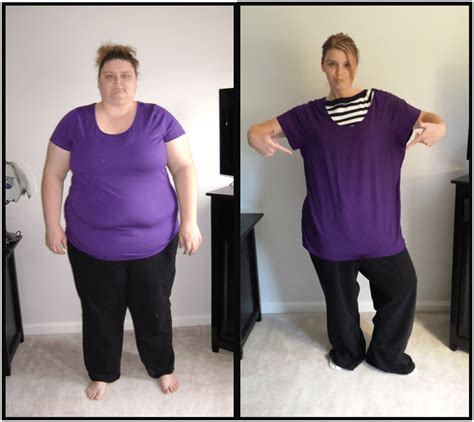 Gastric Bypass Before And After
