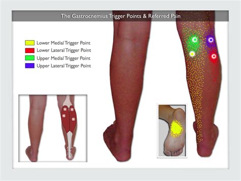 Gastrocnemius Muscle Pain