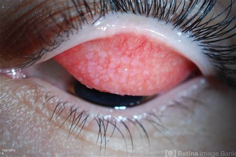 Giant Papillary Conjunctivitis