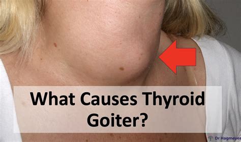 Goiter Disease Causes Revealed