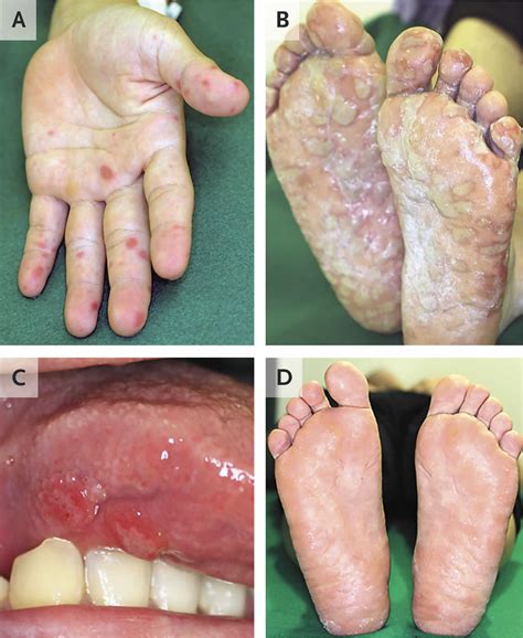 Hand Foot And Mouth