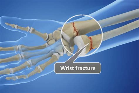 Hand Surgery For Broken Wrist At Mary Greenwell Blog