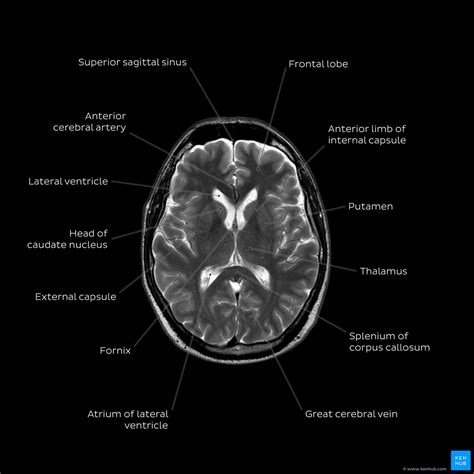 Head Mri Pictures: Understand Your Brain Health